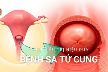 Sa tử cung (Sa sinh dục) là gì? Làm thế nào để nhận biết và chữa trị