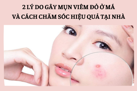 2 lý do gây mụn viêm đỏ ở má bạn bạn nên biết
