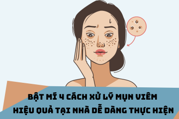 Mách bạn 4 cách trị mụn viêm hiệu quả, an toàn dễ thực hiện tại nhà